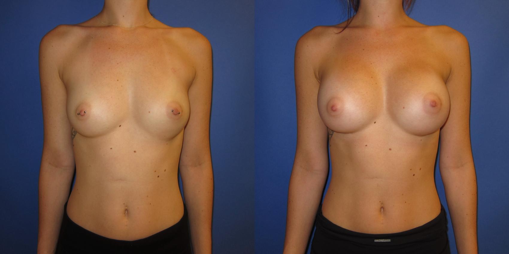 Before & After Breast Augmentation Case 237 View #1 View in Portland, OR