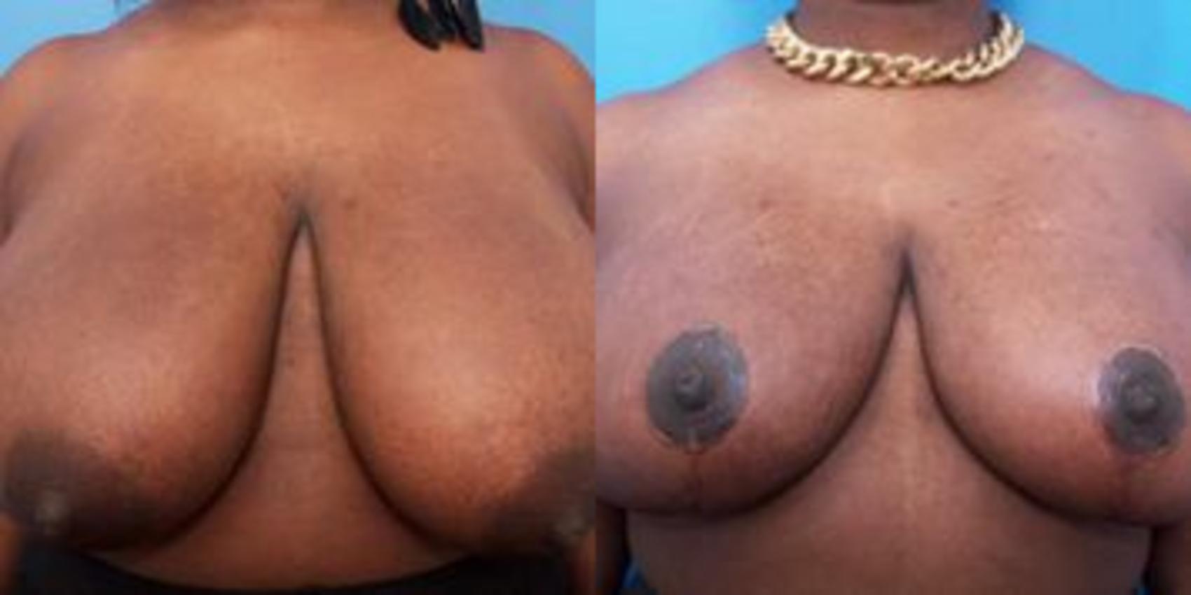 Before & After Breast Reconstruction Case 233 View #1 View in Portland, OR