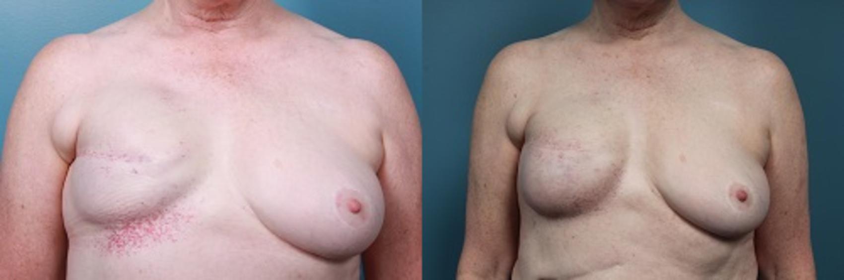 Before & After Breast Reconstruction Case 48 View #1 View in Portland, OR