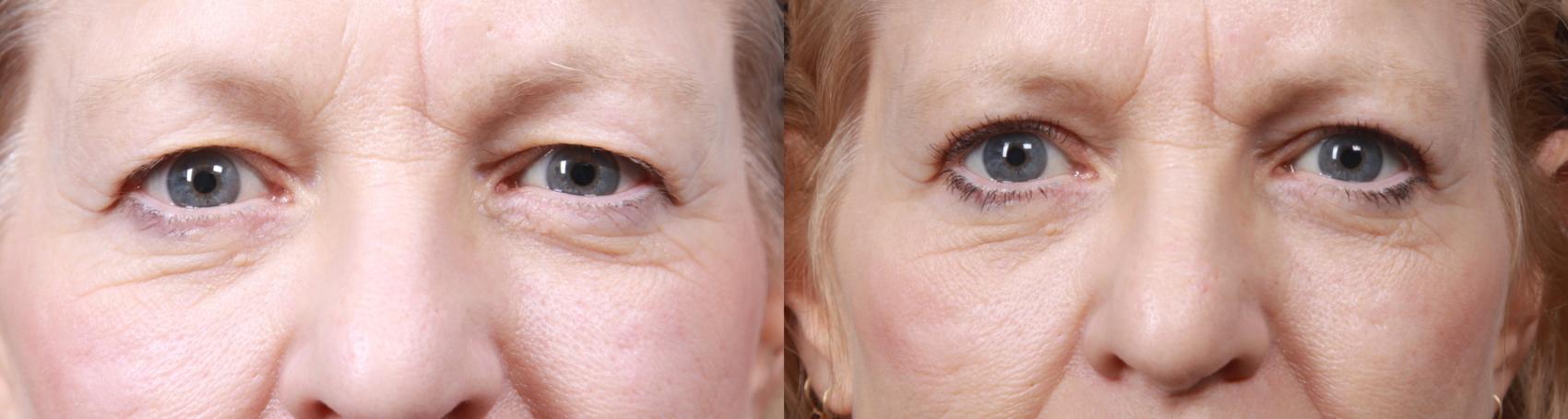 Before & After Eyelid Surgery (Blepharoplasty) Case 31 View #1 View in Portland, OR