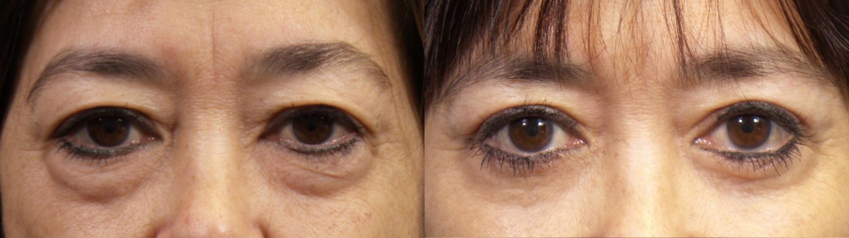 Before & After Eyelid Surgery (Blepharoplasty) Case 95 View #1 View in Portland, OR