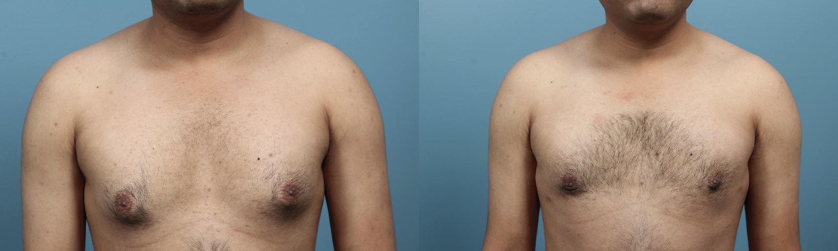 Before & After Male Breast Reduction (Gynecomastia) Case 102 View #2 View in Portland, OR