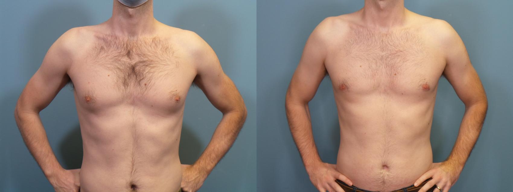 Before & After Male Breast Reduction (Gynecomastia) Case 422 Front View in Portland, OR