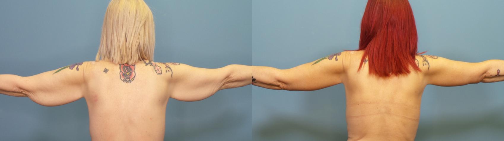 Before & After Arm Lift Case 316 Back View in Portland, OR