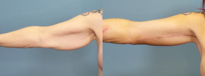 Before & After Arm Lift Case 316 Right Side View in Portland, OR