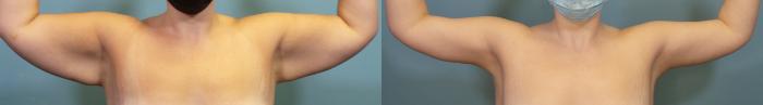 Before & After Arm Lift Case 342 Front View in Portland, OR