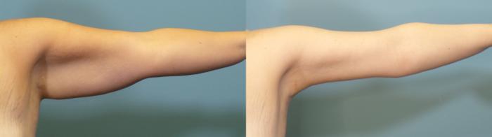 Before & After Arm Lift Case 342 Left Side View in Portland, OR