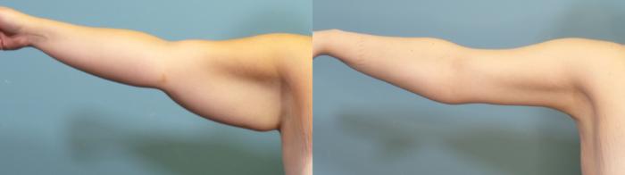 Before & After Arm Lift Case 342 Right Side View in Portland, OR