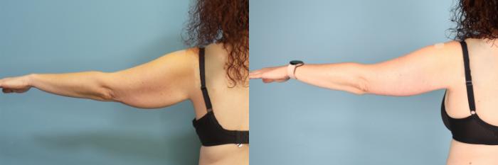 Before & After Arm Lift Case 365 Back View in Portland, OR