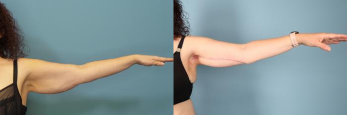 Before & After Arm Lift Case 365 Front View in Portland, OR