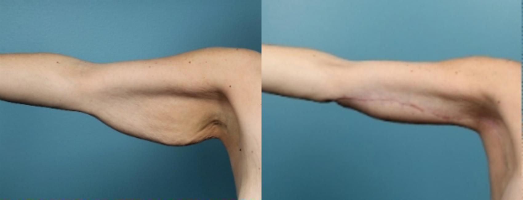 Before & After Arm Lift Case 59 View #1 View in Portland, OR