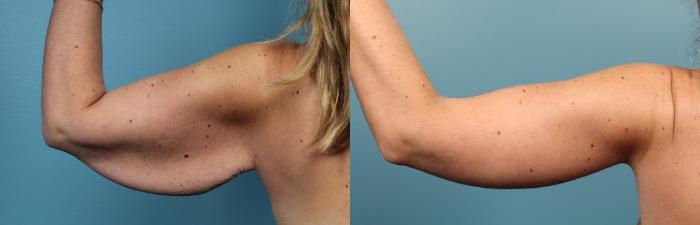 Before & After Arm Lift Case 59 View #2 View in Portland, OR