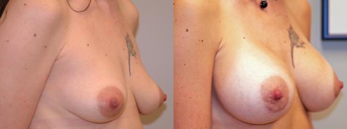 Before & After Breast Augmentation Case 1 View #2 View in Portland, OR