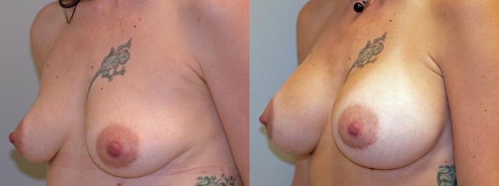 Before & After Breast Augmentation Case 1 View #3 View in Portland, OR