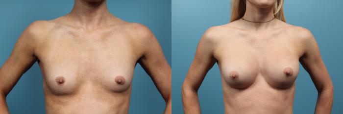 Before & After Breast Augmentation Case 103 View #1 View in Portland, OR