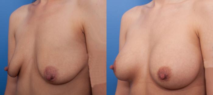 Before & After Breast Augmentation Case 11 View #2 View in Portland, OR
