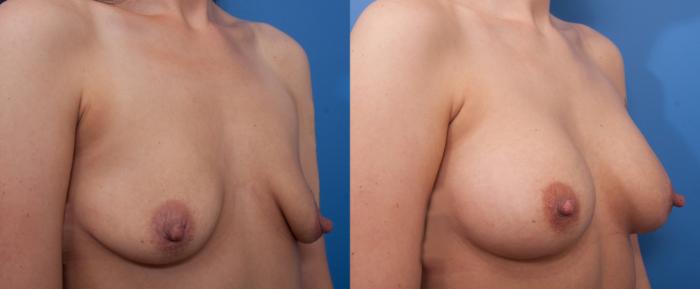 Before & After Breast Augmentation Case 11 View #3 View in Portland, OR