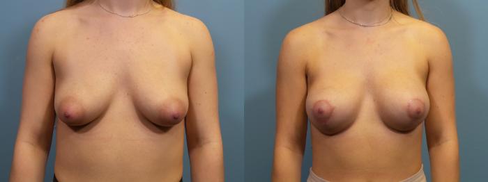 Before & After Breast Augmentation Case 115 View #1 View in Portland, OR