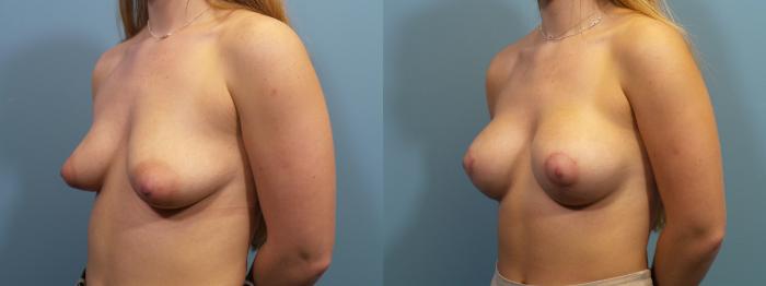 Before & After Breast Augmentation Case 115 View #2 View in Portland, OR