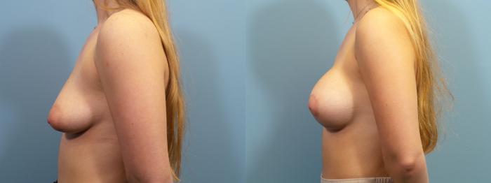 Before & After Breast Augmentation Case 115 View #3 View in Portland, OR