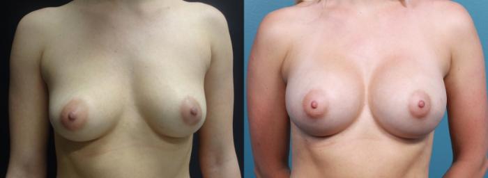 Before & After Breast Augmentation Case 12 View #1 View in Portland, OR
