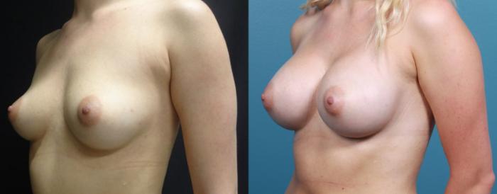 Before & After Breast Augmentation Case 12 View #2 View in Portland, OR