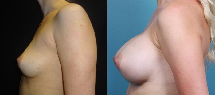 Before & After Breast Augmentation Case 12 View #3 View in Portland, OR
