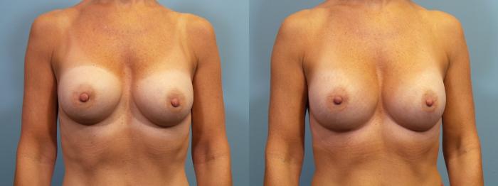 Before & After Breast Augmentation Case 123 View #1 View in Portland, OR