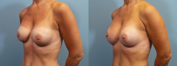 Before & After Breast Augmentation Case 123 View #2 View in Portland, OR