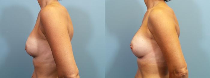 Before & After Breast Augmentation Case 123 View #3 View in Portland, OR