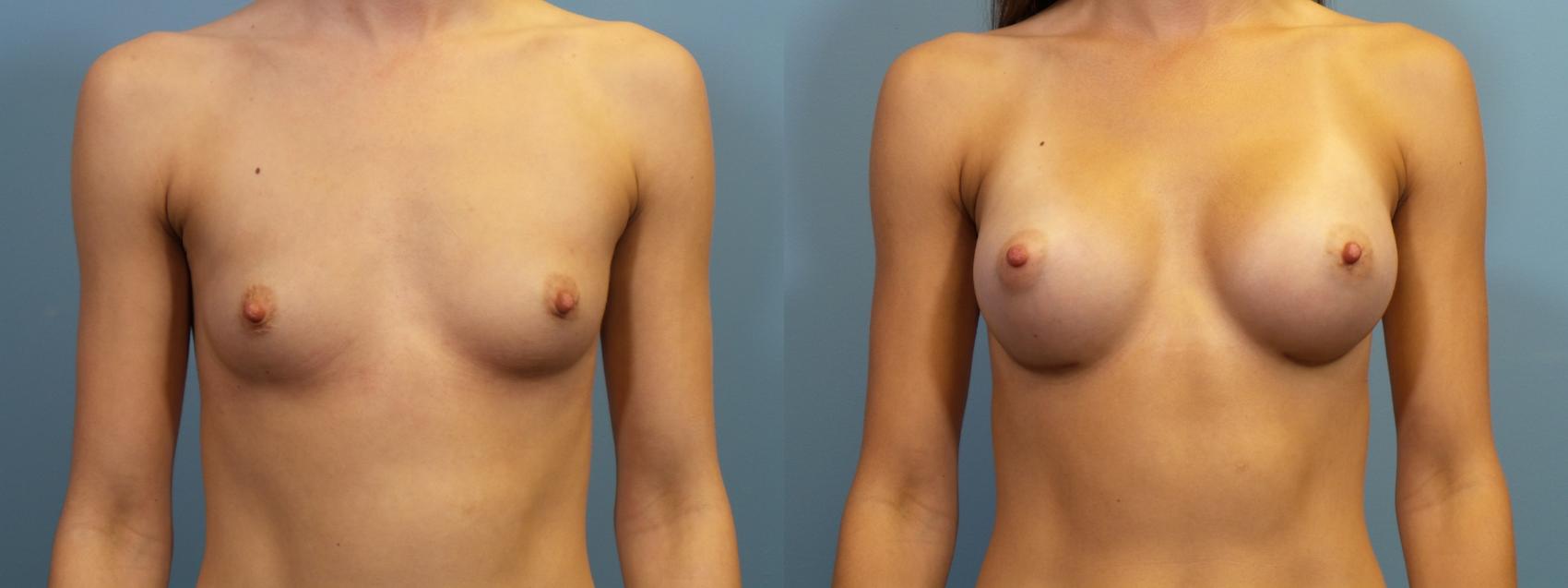 Before & After Breast Augmentation Case 124 View #1 View in Portland, OR