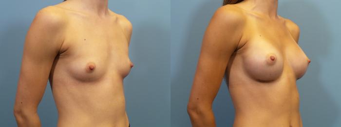 Before & After Breast Augmentation Case 124 View #2 View in Portland, OR