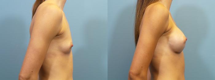Before & After Breast Augmentation Case 124 View #3 View in Portland, OR