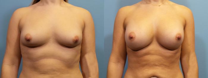 Before & After Breast Augmentation Case 126 View #1 View in Portland, OR