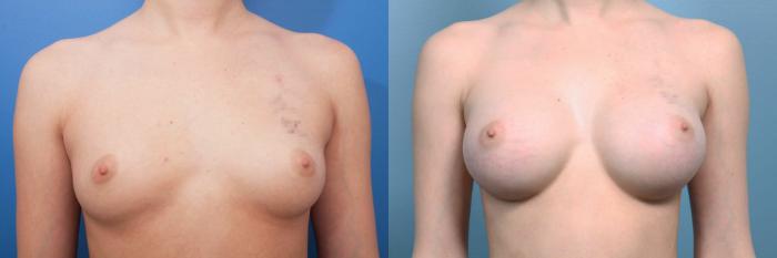 Before & After Breast Augmentation Case 16 View #1 View in Portland, OR