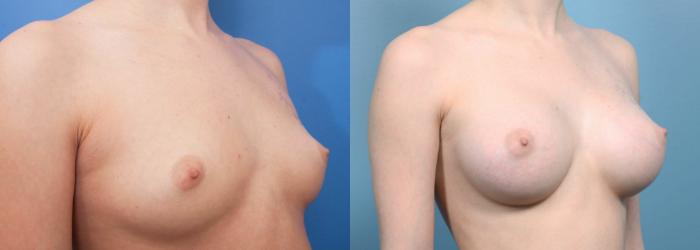 Before & After Breast Augmentation Case 16 View #2 View in Portland, OR