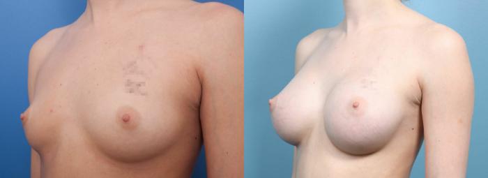 Before & After Breast Augmentation Case 16 View #3 View in Portland, OR