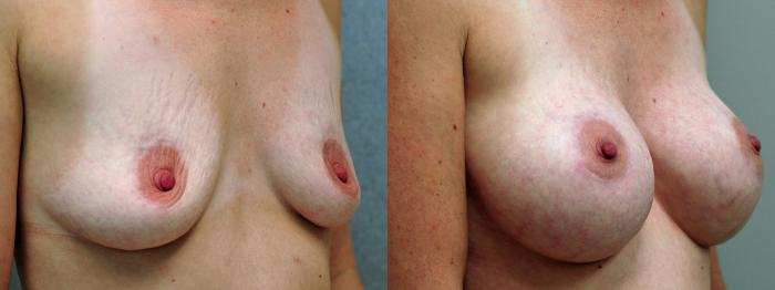 Before & After Breast Augmentation Case 2 View #2 View in Portland, OR