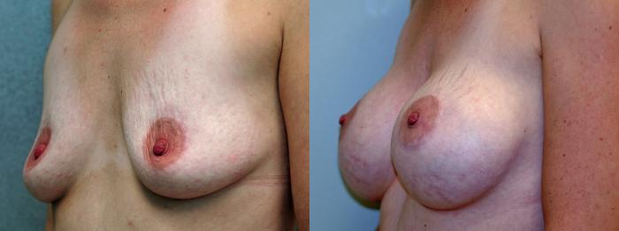 Before & After Breast Augmentation Case 2 View #3 View in Portland, OR