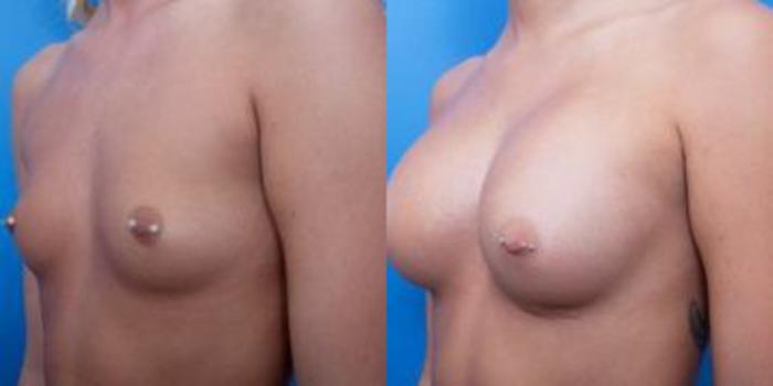 Before & After Breast Augmentation Case 21 View #2 View in Portland, OR
