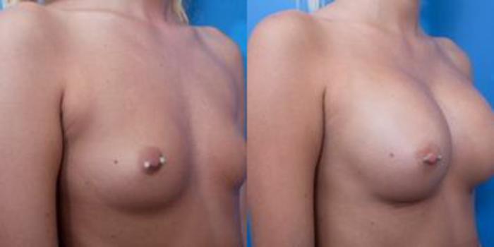 Before & After Breast Augmentation Case 21 View #3 View in Portland, OR