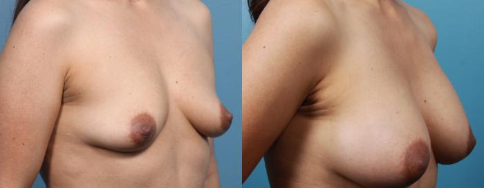 Before & After Breast Augmentation Case 23 View #2 View in Portland, OR