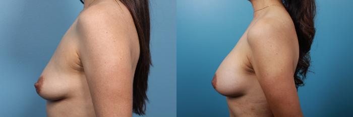 Before & After Breast Augmentation Case 23 View #3 View in Portland, OR