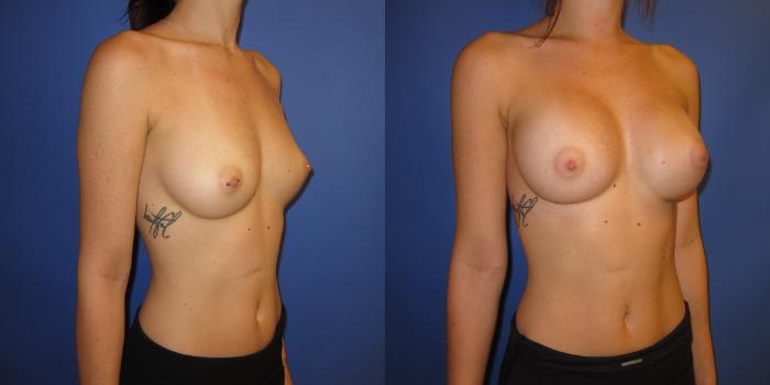 Before & After Breast Augmentation Case 237 View #2 View in Portland, OR