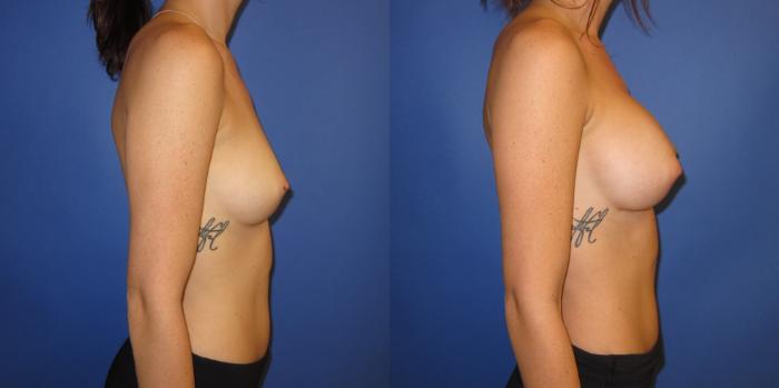 Before & After Breast Augmentation Case 237 View #3 View in Portland, OR