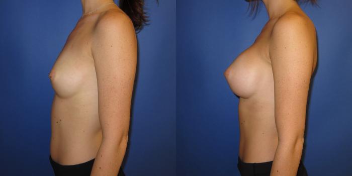 Before & After Breast Augmentation Case 237 View #4 View in Portland, OR