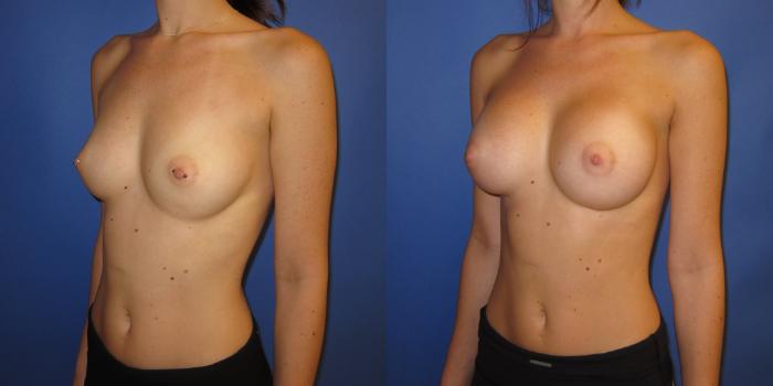 Before & After Breast Augmentation Case 237 View #5 View in Portland, OR