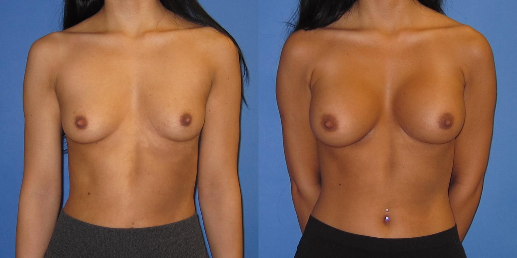 Before & After Breast Augmentation Case 238 View #1 View in Portland, OR