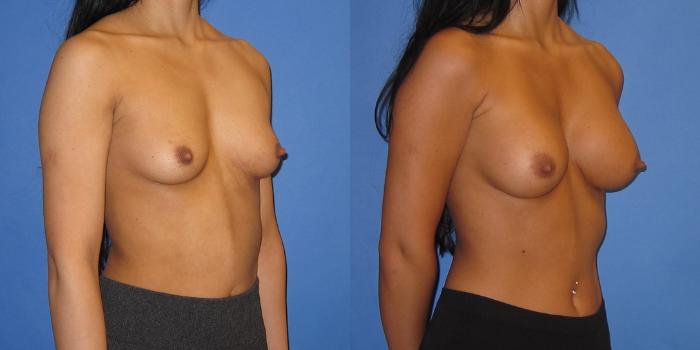 Before & After Breast Augmentation Case 238 View #2 View in Portland, OR