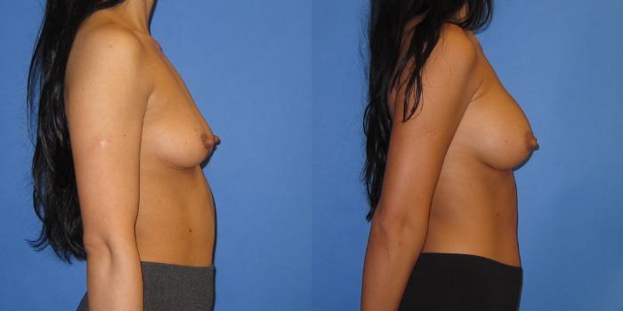 Before & After Breast Augmentation Case 238 View #3 View in Portland, OR